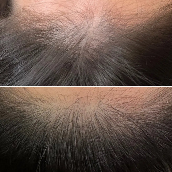 hair-restoration-before-and-after-by-tgs-lab-1