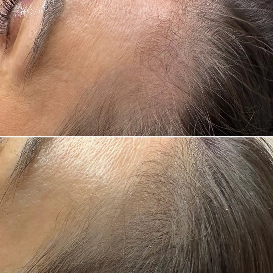 hair-restoration-before-and-after-by-tgs-lab-3