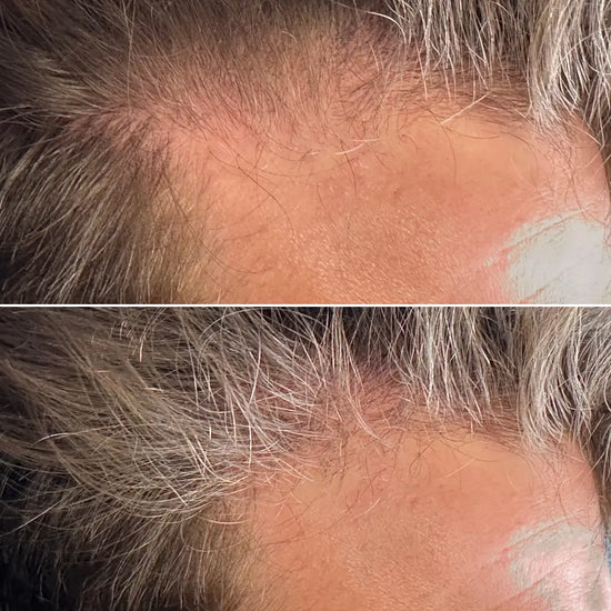 hair-restoration-before-and-after-by-tgs-lab-4